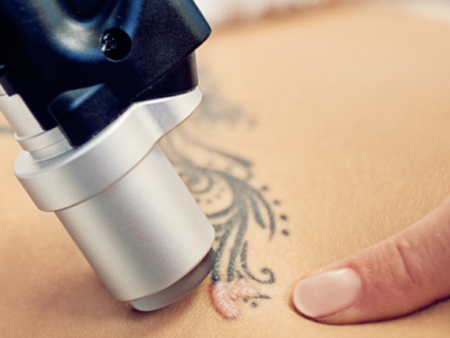 Box klein tattooentfernung