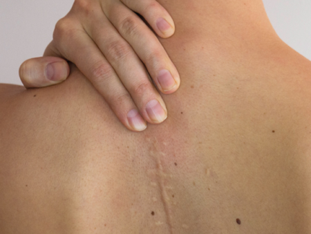 Box narbenbehandlung