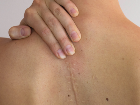 Box narbenbehandlung